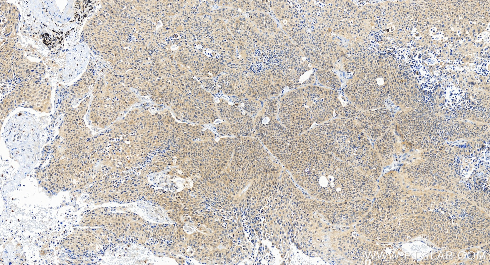 IHC staining of human lung cancer using 80821-2-RR