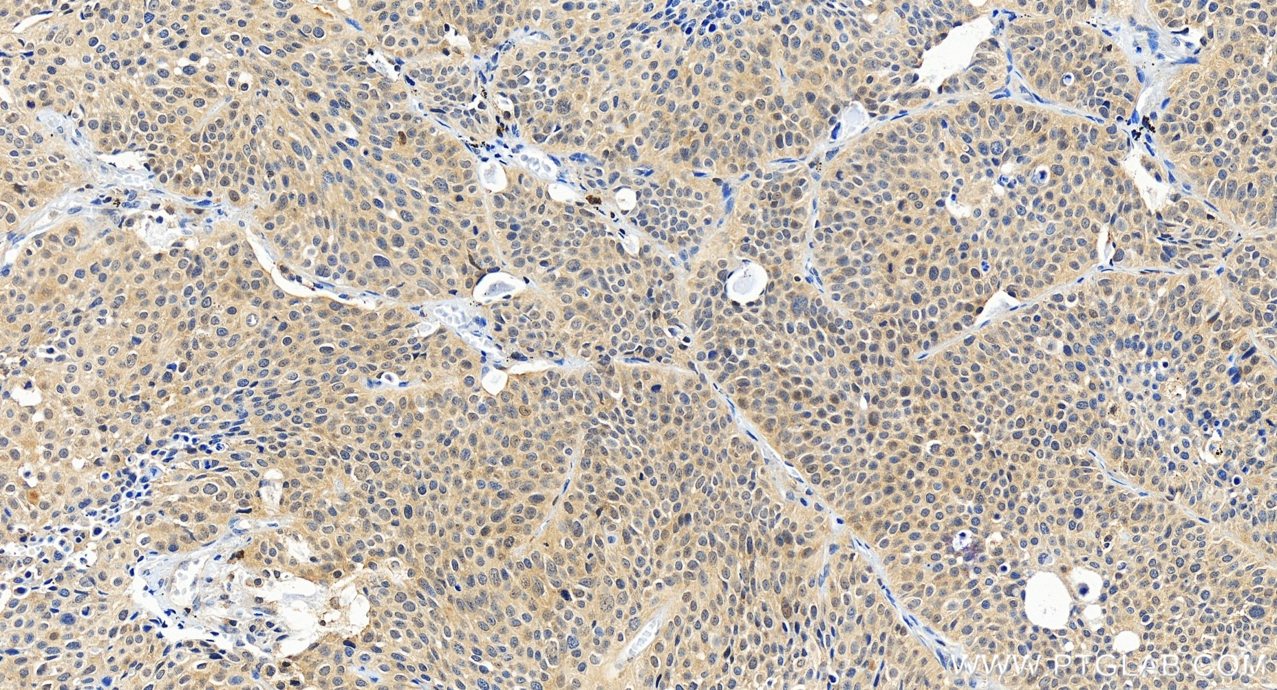 IHC staining of human lung cancer using 80821-2-RR