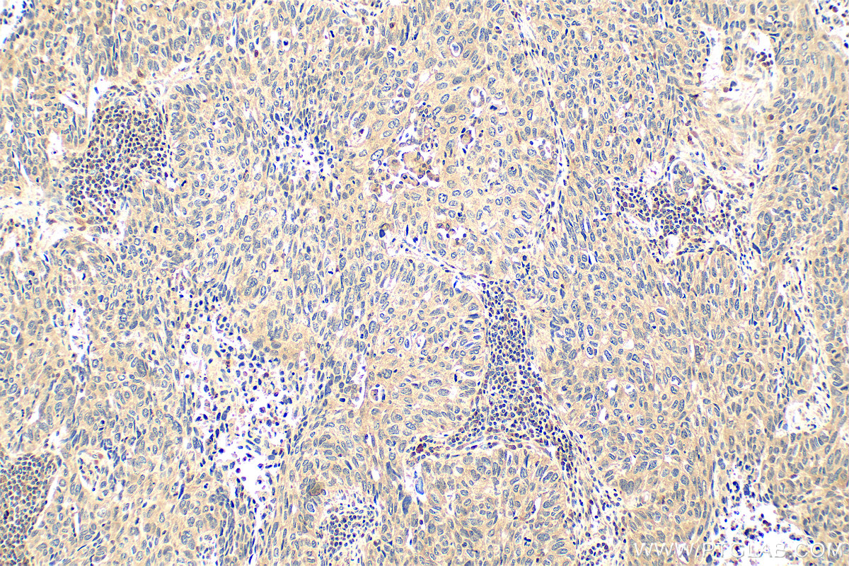 IHC staining of human lung cancer using RMX00006