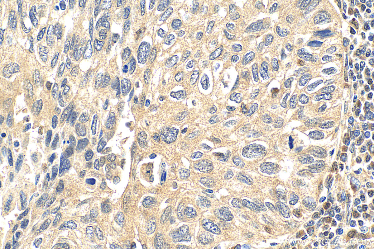 IHC staining of human lung cancer using RMX00006