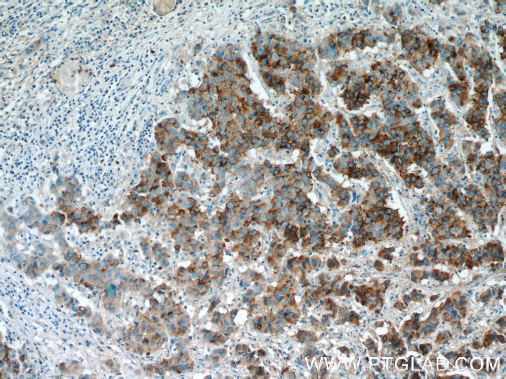 IHC staining of human prostate cancer using 15918-1-AP