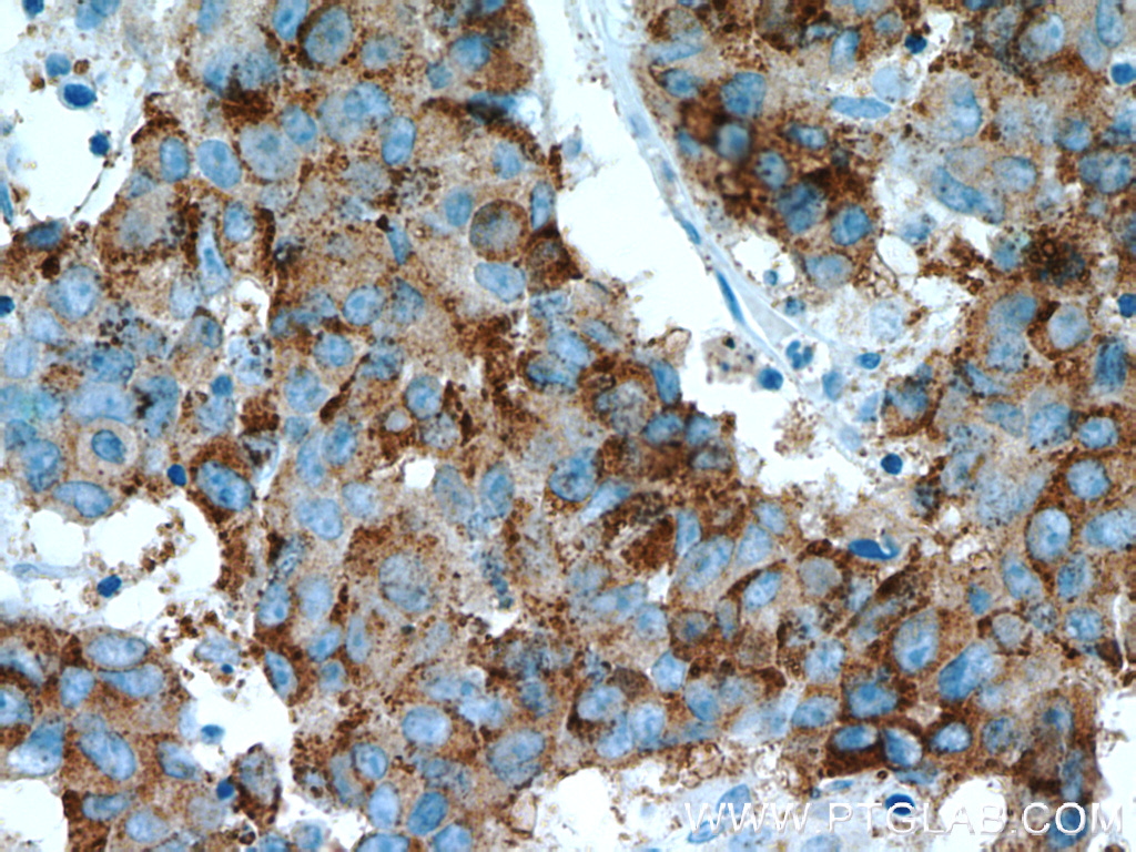 IHC staining of human prostate cancer using 15918-1-AP