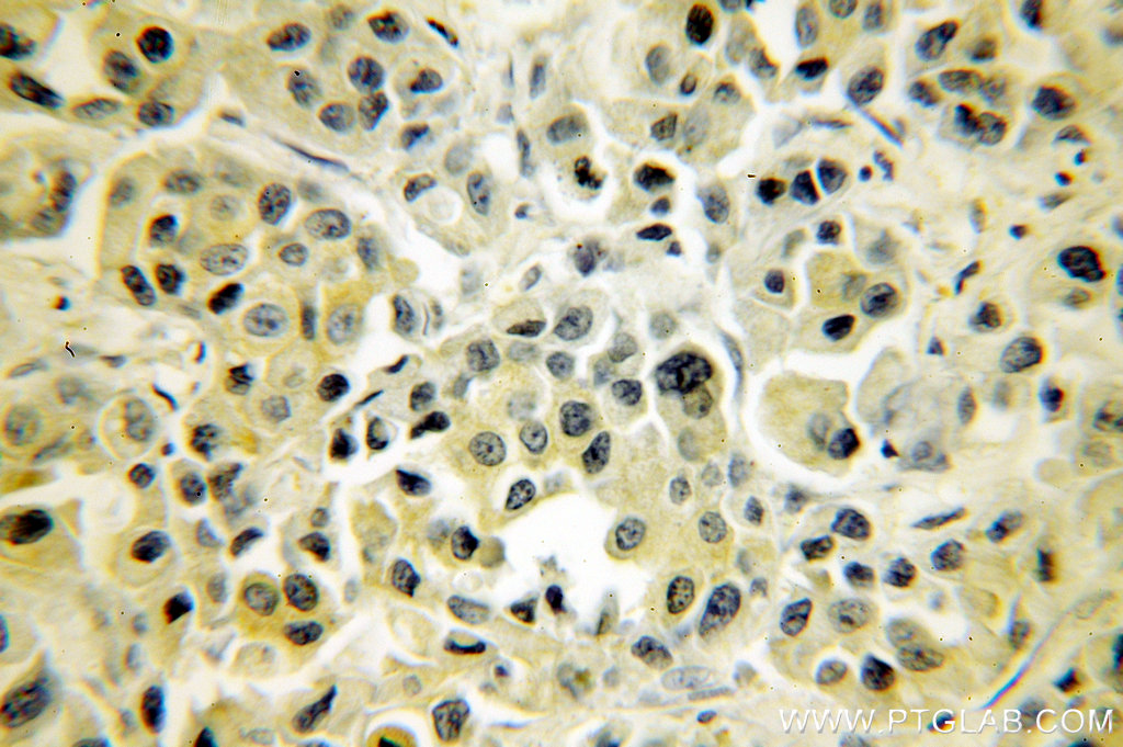 IHC staining of human breast cancer using 10745-1-AP