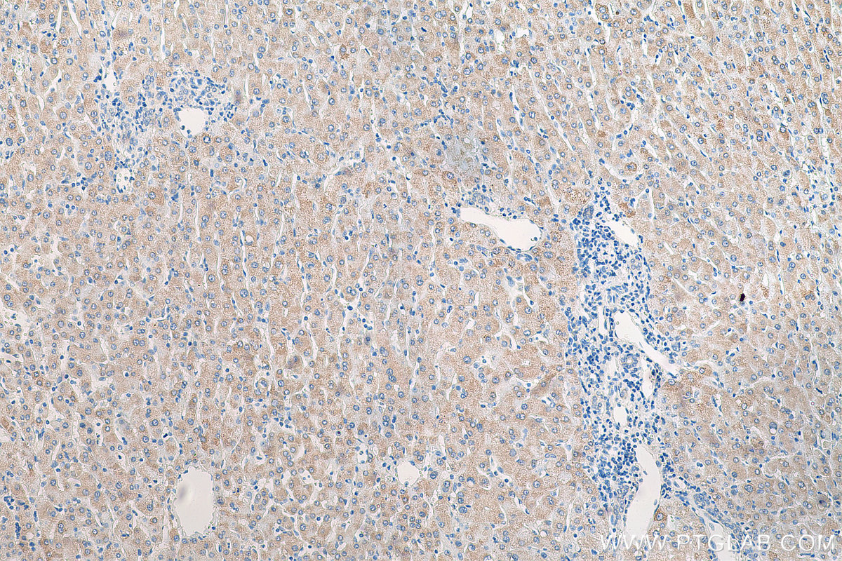 IHC staining of human liver cancer using 14485-1-AP