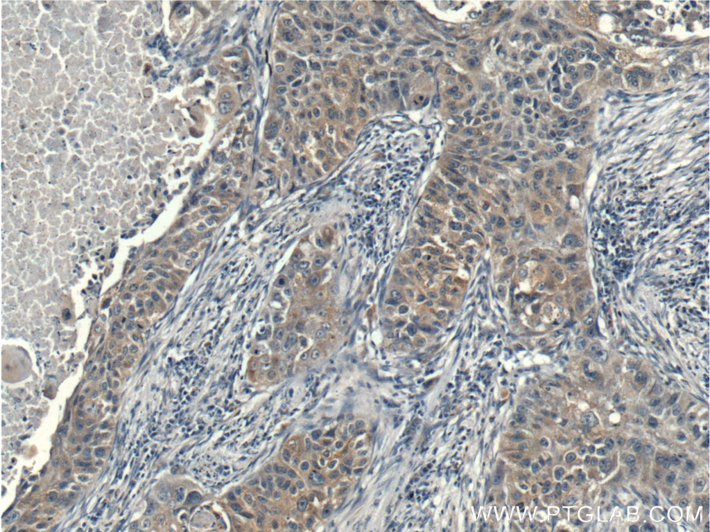 IHC staining of human lung cancer using 26587-1-AP
