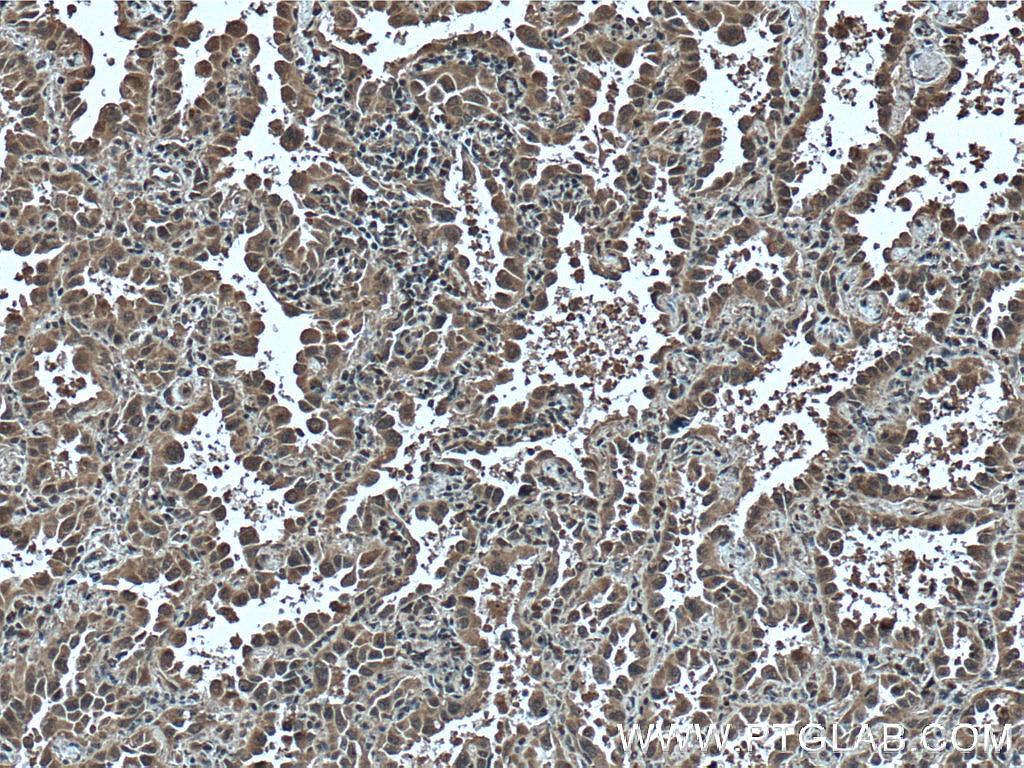 IHC staining of human lung cancer using 66638-1-Ig (same clone as 66638-1-PBS)