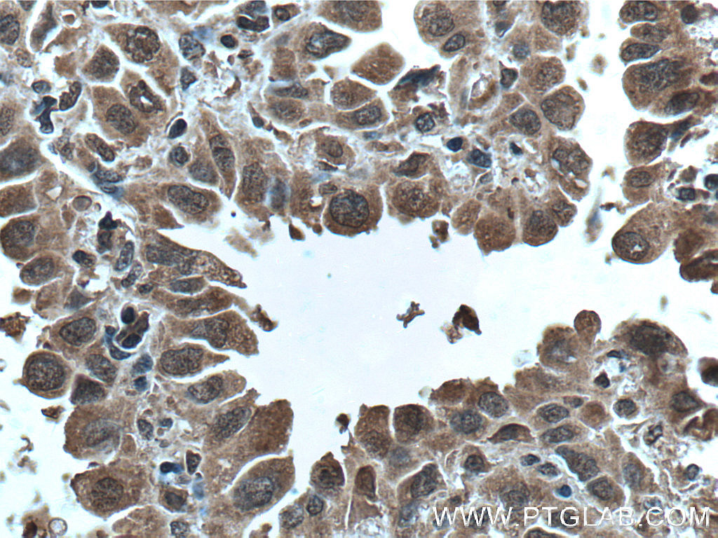 IHC staining of human lung cancer using 66638-1-Ig (same clone as 66638-1-PBS)