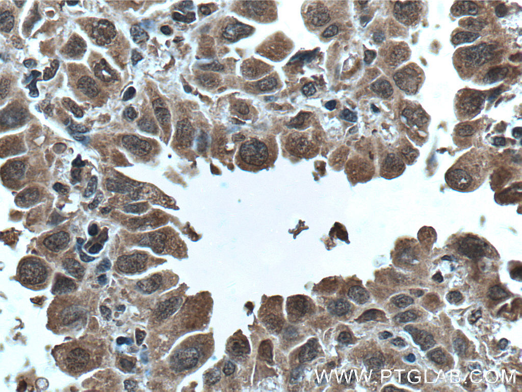 IHC staining of human lung cancer using 66638-1-Ig