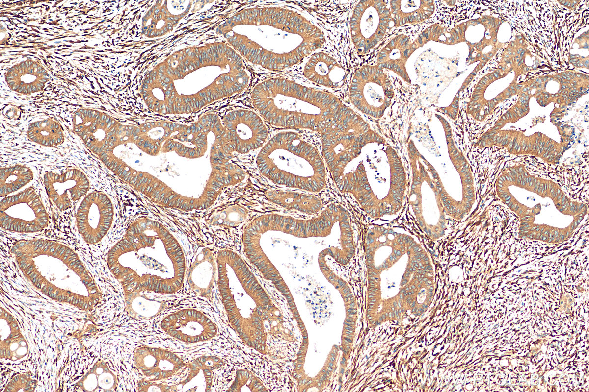 IHC staining of human colon cancer using 81615-1-RR