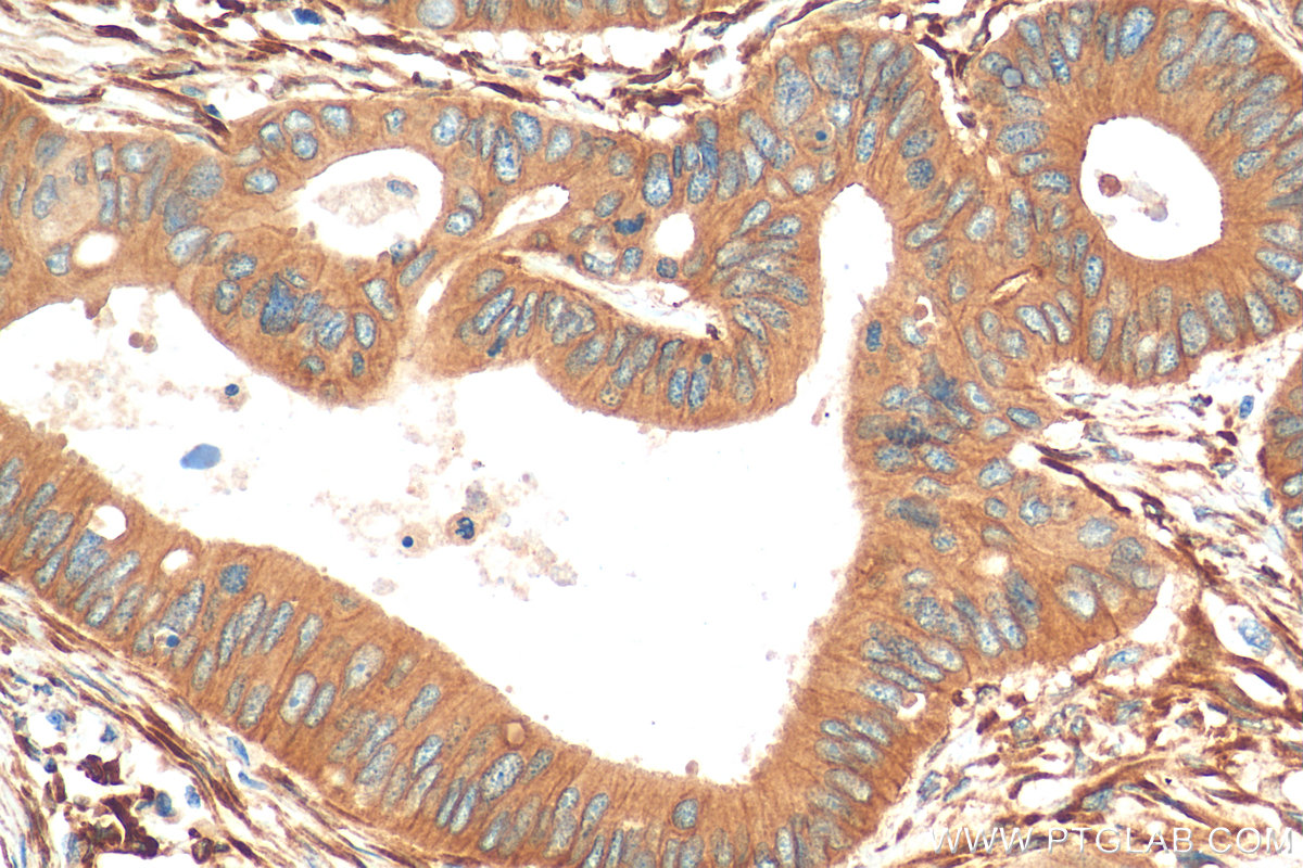 IHC staining of human colon cancer using 81615-1-RR