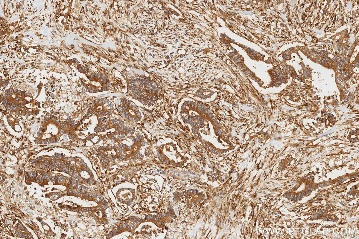 IHC staining of human rectal cancer using 81615-1-RR (same clone as 81615-1-PBS) IHC staining of human rectal cancer using 81615-1-RR (same clone as 81615-1-PBS)