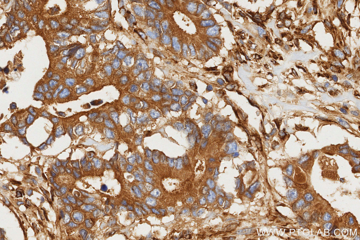 IHC staining of human rectal cancer using 81615-1-RR (same clone as 81615-1-PBS) IHC staining of human rectal cancer using 81615-1-RR (same clone as 81615-1-PBS)