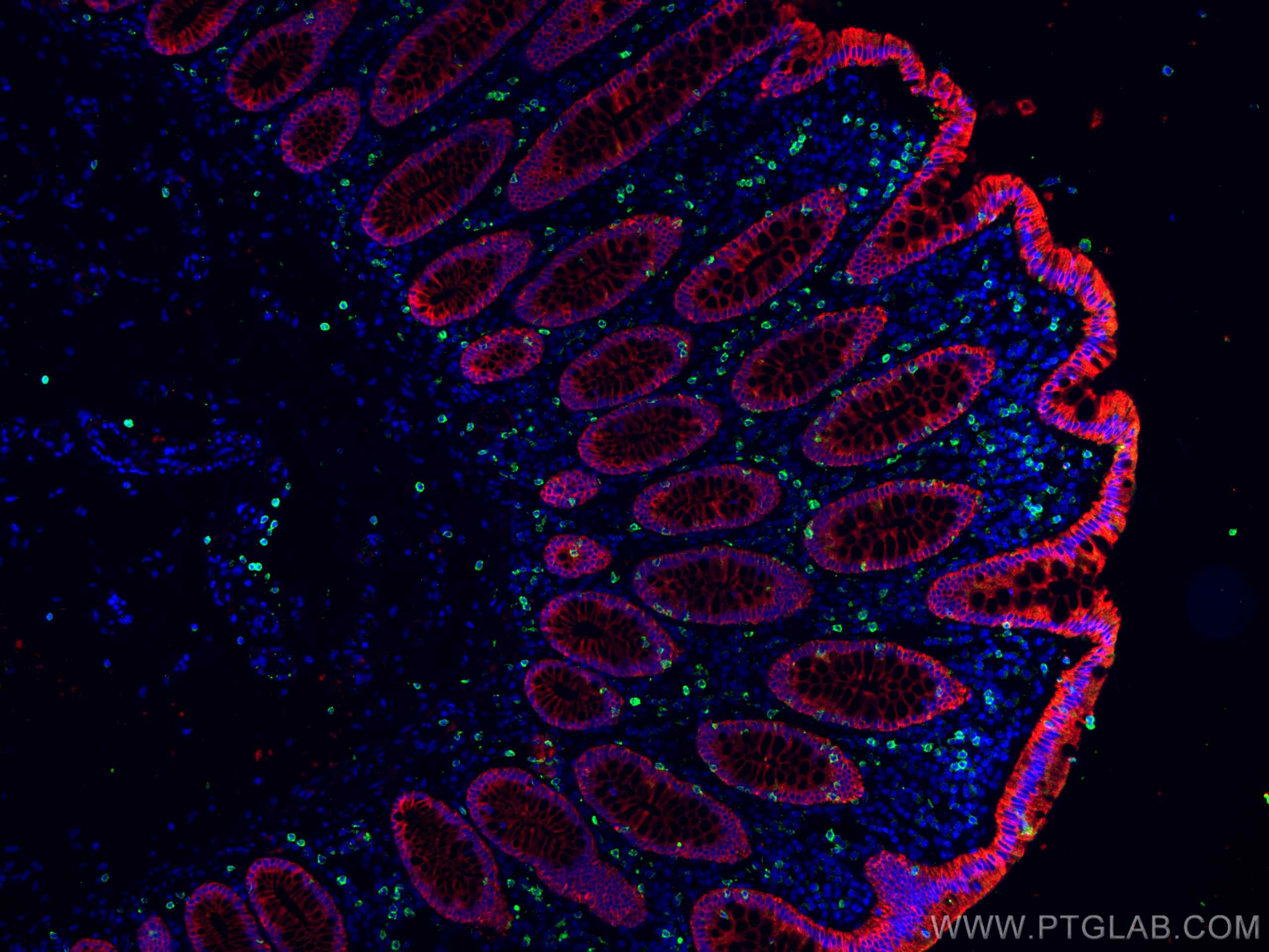 IF Staining of human colon cancer using 26411-1-AP