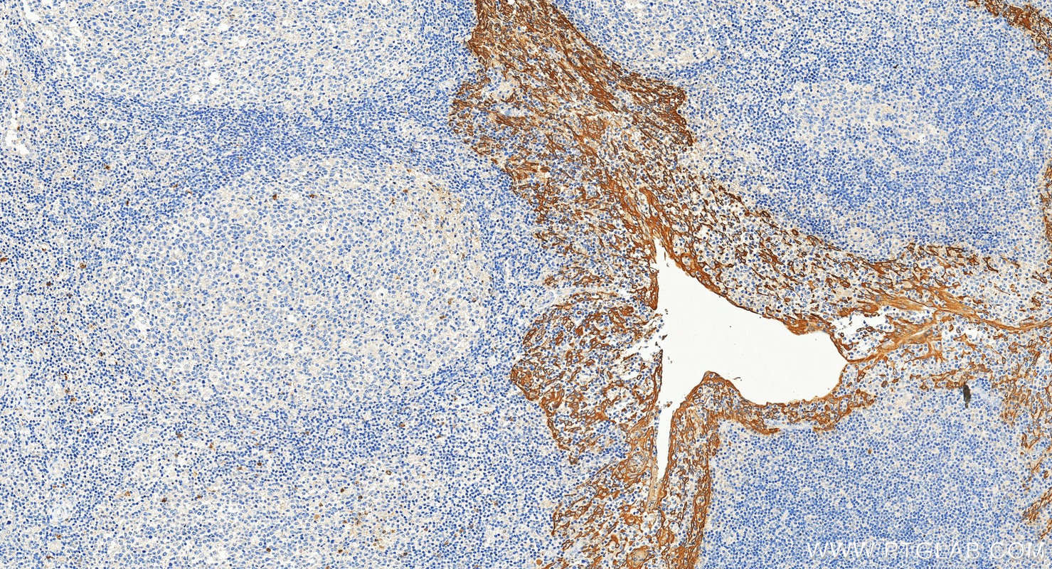 IHC staining of human tonsillitis using 26411-1-AP