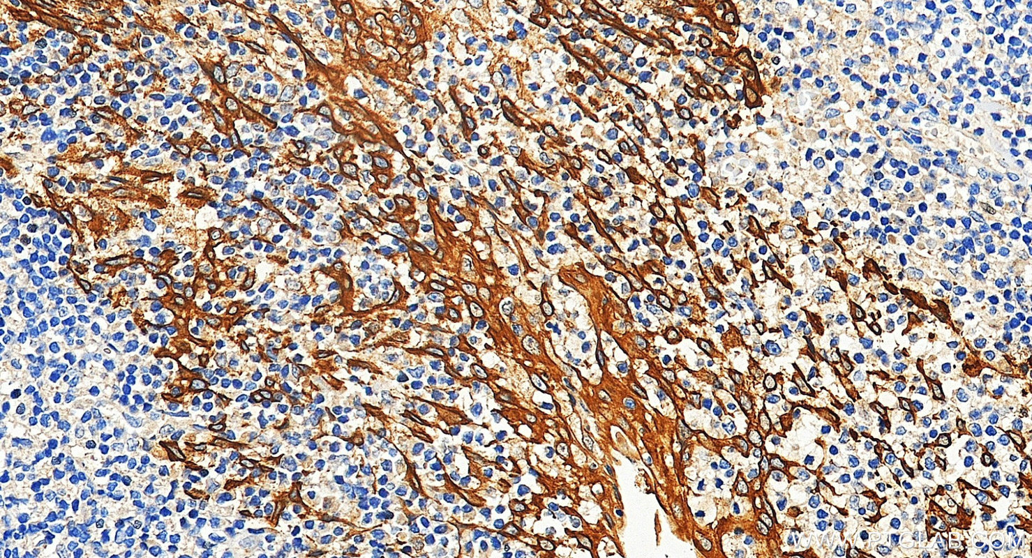 IHC staining of human tonsillitis using 26411-1-AP