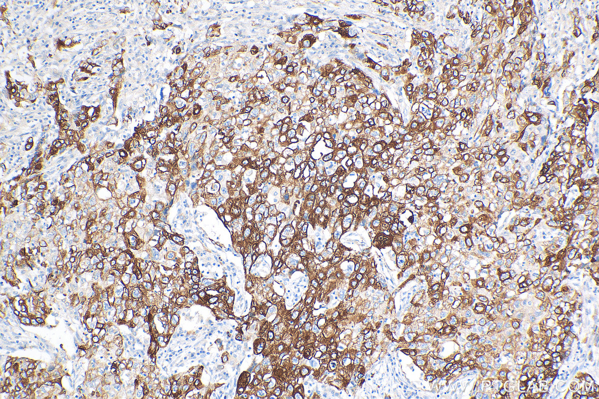 Immunohistochemical analysis of paraffin-embedded human lung adenocarcinoma tissue slide using 82548-3-RR (KRT5 antibody) at dilution of 1:1000 (under 10x lens). Heat mediated antigen retrieval with Tris-EDTA buffer (pH 9.0). IHC staining of human lung cancer using 82548-3-RR