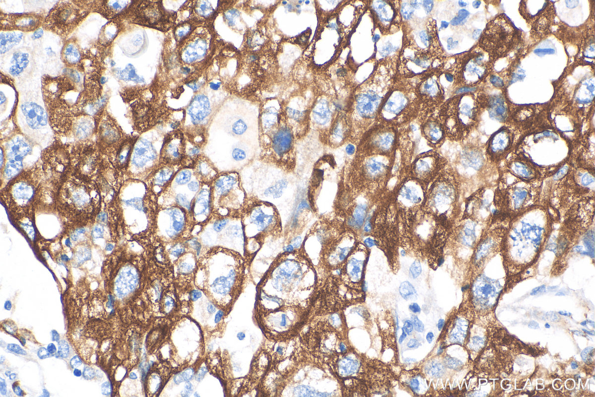 Immunohistochemical analysis of paraffin-embedded human lung adenocarcinoma tissue slide using 82548-3-RR (KRT5 antibody) at dilution of 1:1000 (under 40x lens). Heat mediated antigen retrieval with Tris-EDTA buffer (pH 9.0). IHC staining of human lung cancer using 82548-3-RR