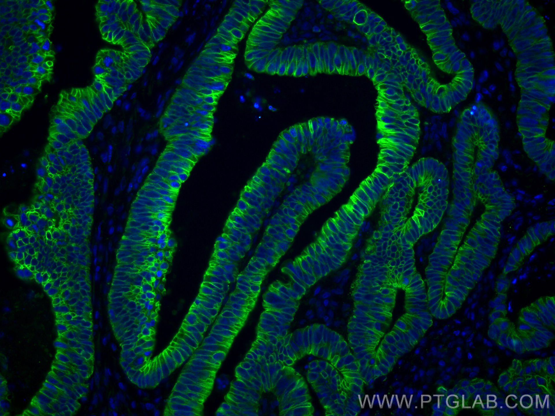 IF Staining of human colon cancer using CL488-26411