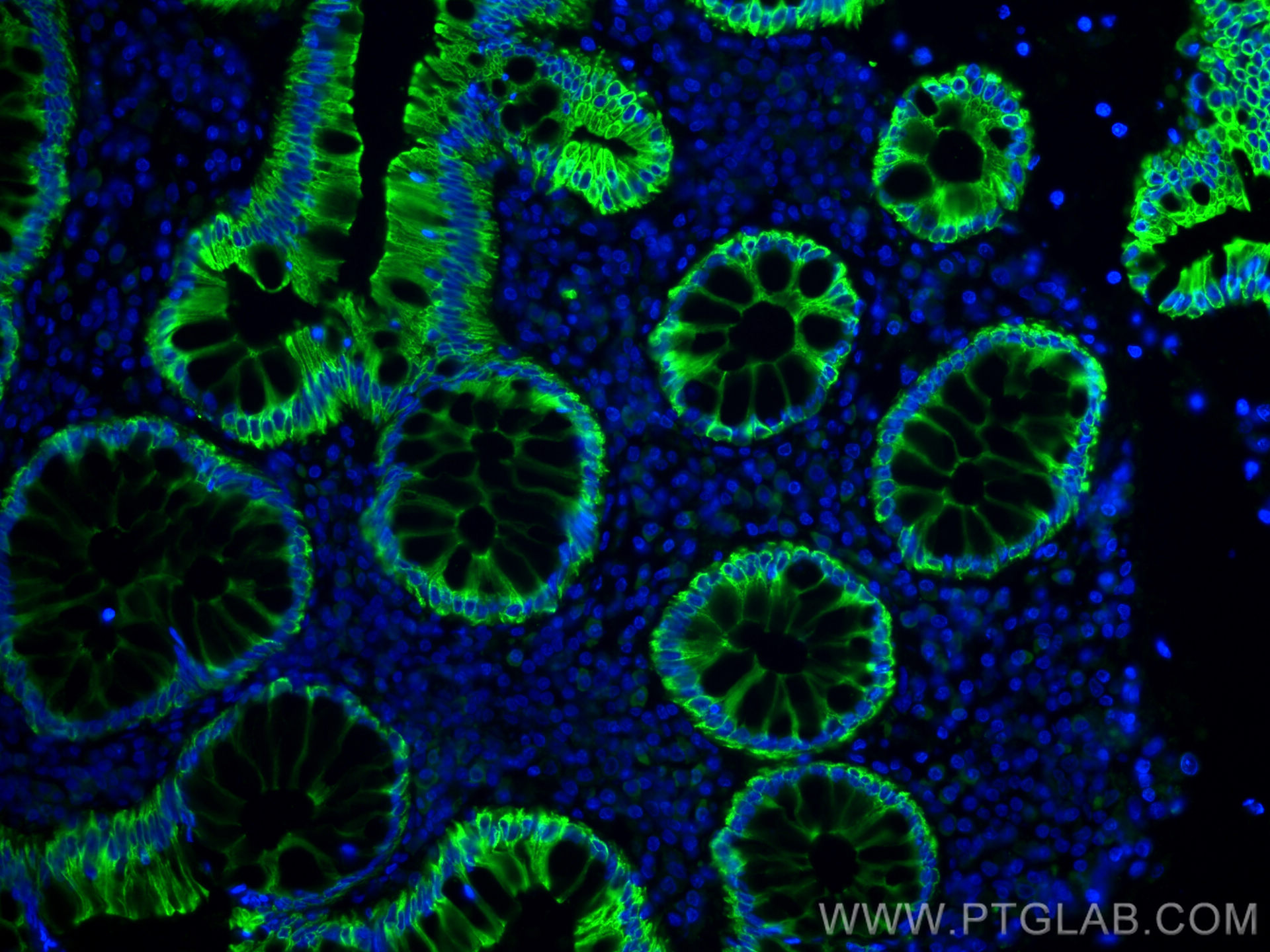 IF Staining of human colon cancer using CL488-26411