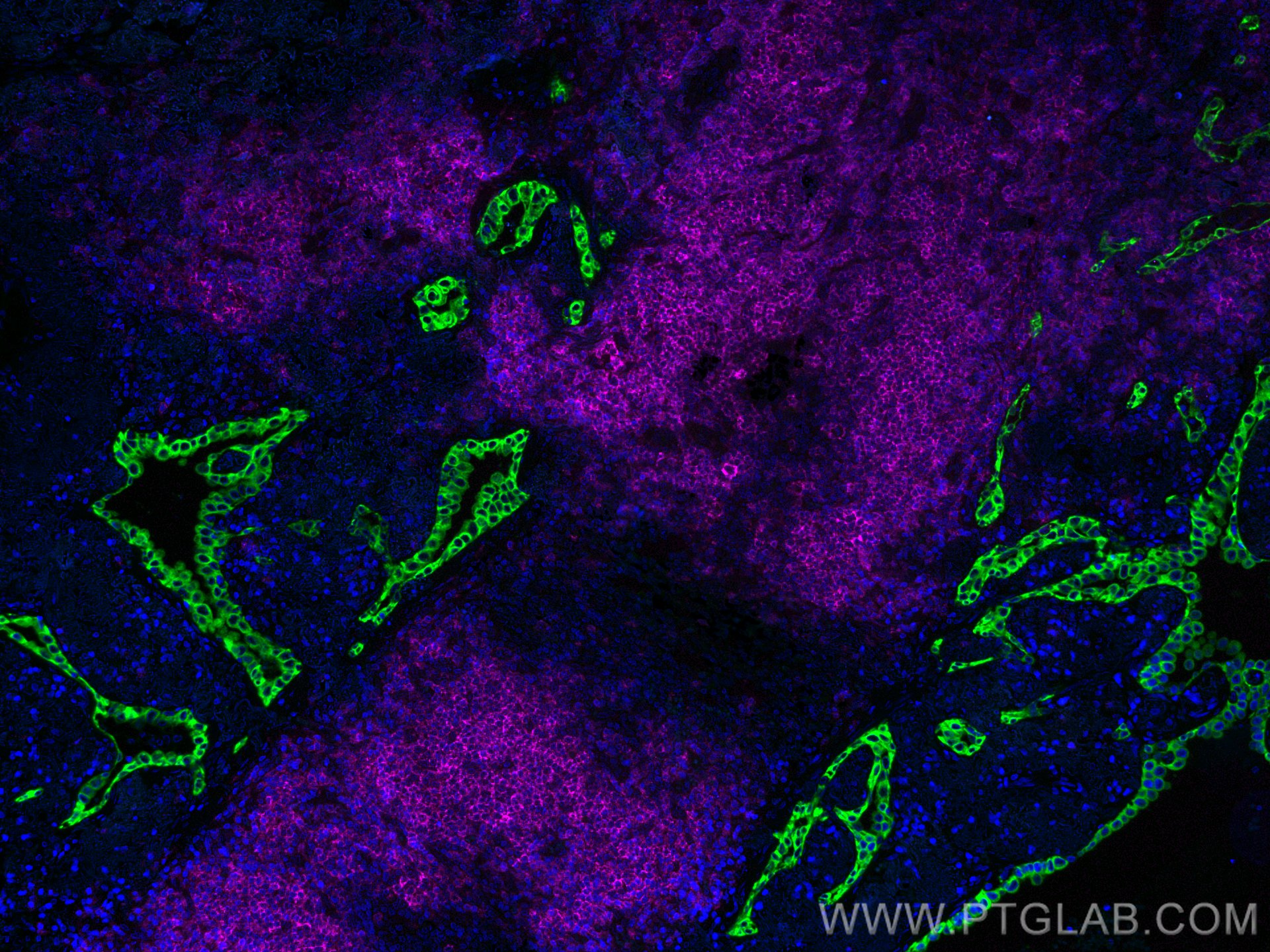 IF Staining of human lung cancer using CL488-26411