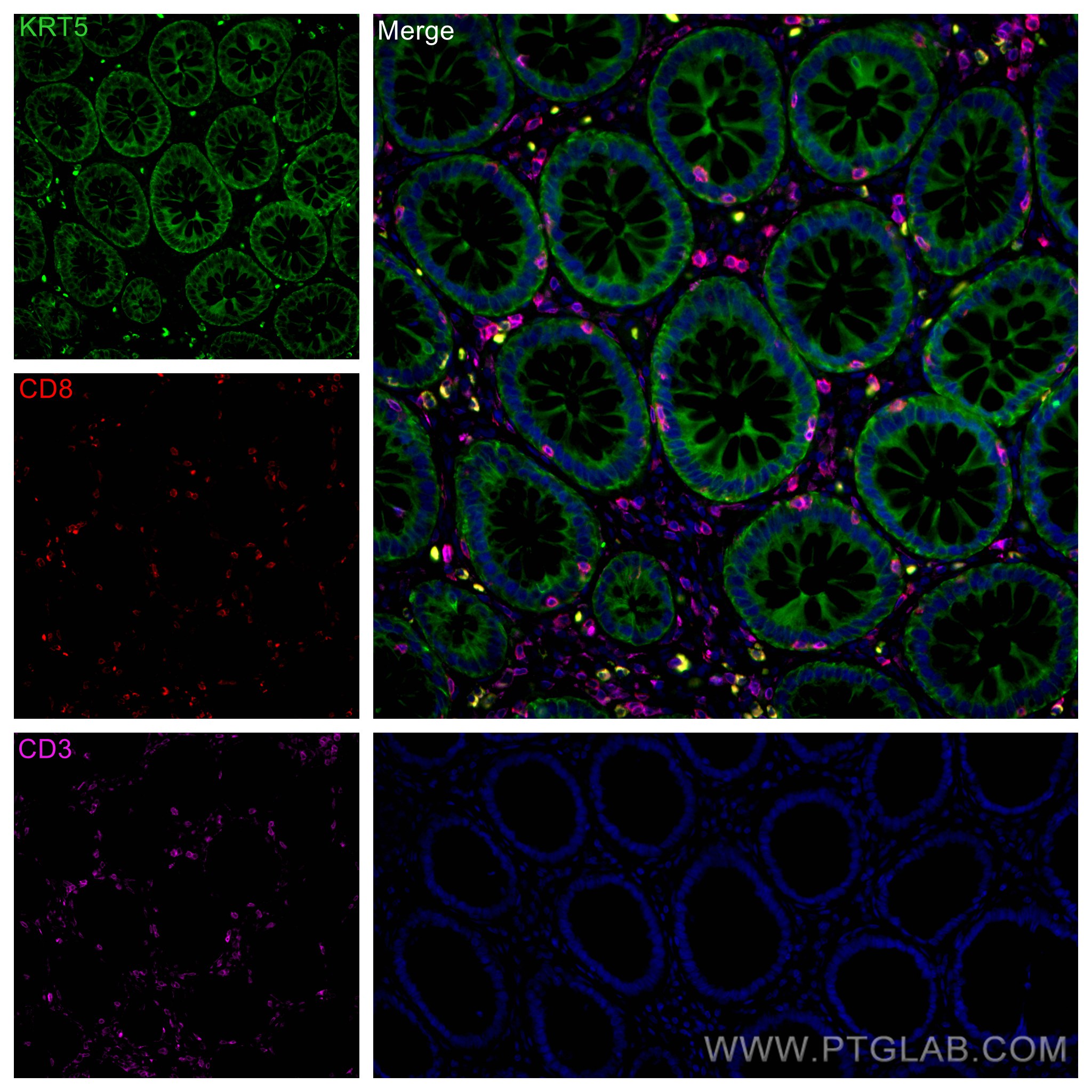 IF Staining of human colon cancer using CL488-26411