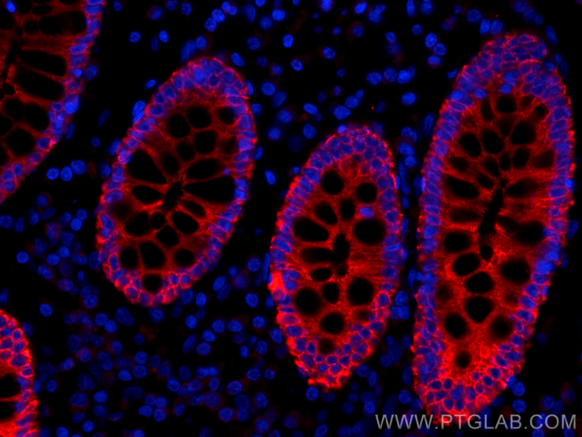 IF Staining of human colon cancer using CL555-26411