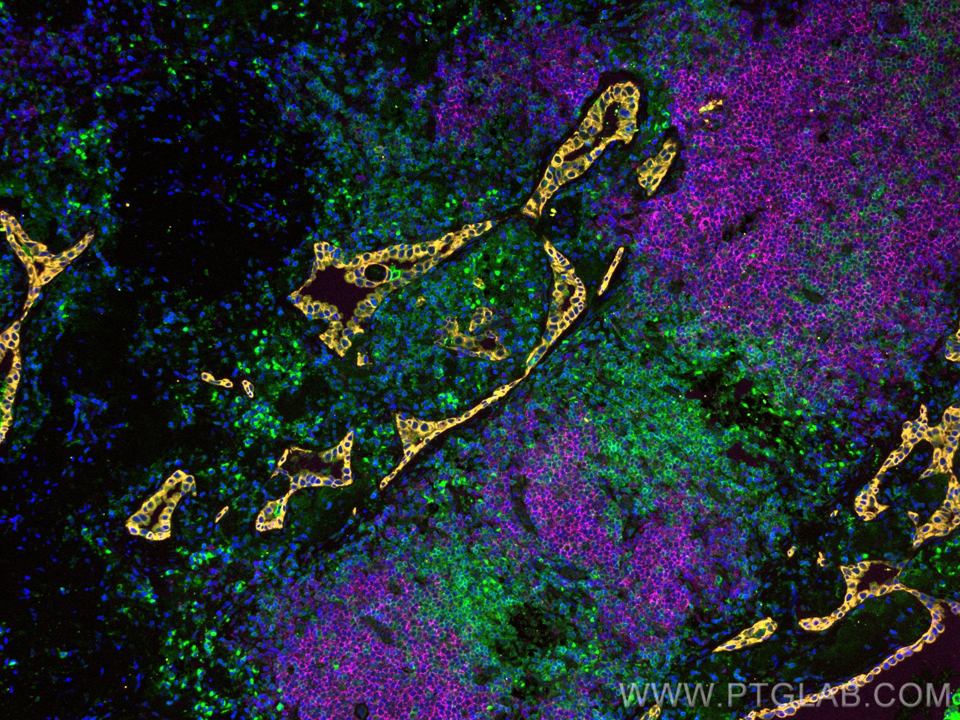 IF Staining of human lung cancer using CL555-26411