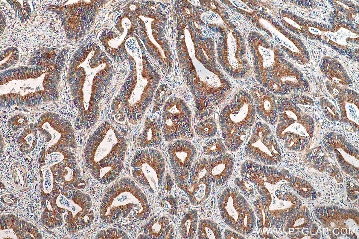 IHC staining of human colon cancer using 66031-1-Ig (same clone as 66031-1-PBS)