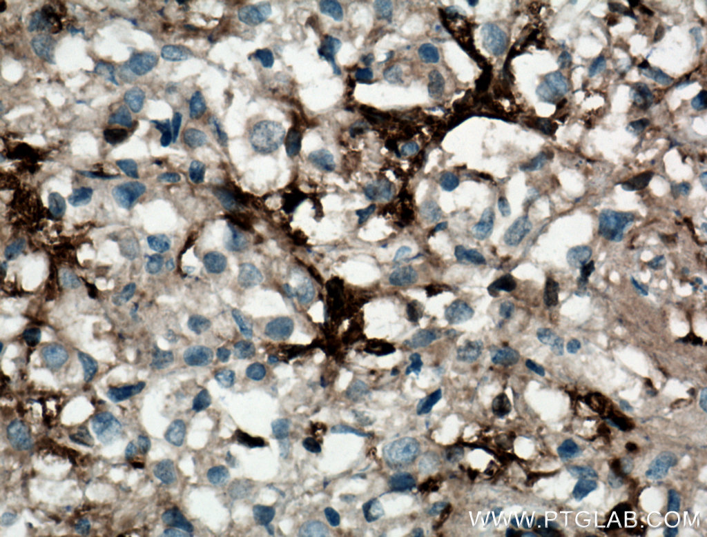 IHC staining of human breast cancer using 66320-1-Ig