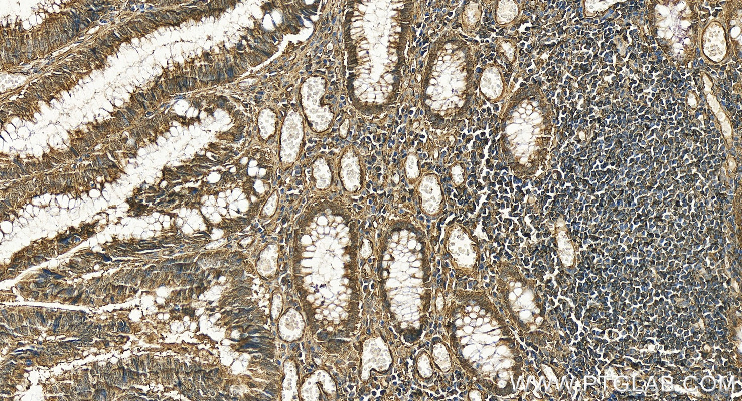 IHC staining of human colon cancer using 82953-1-RR (same clone as 82953-1-PBS)