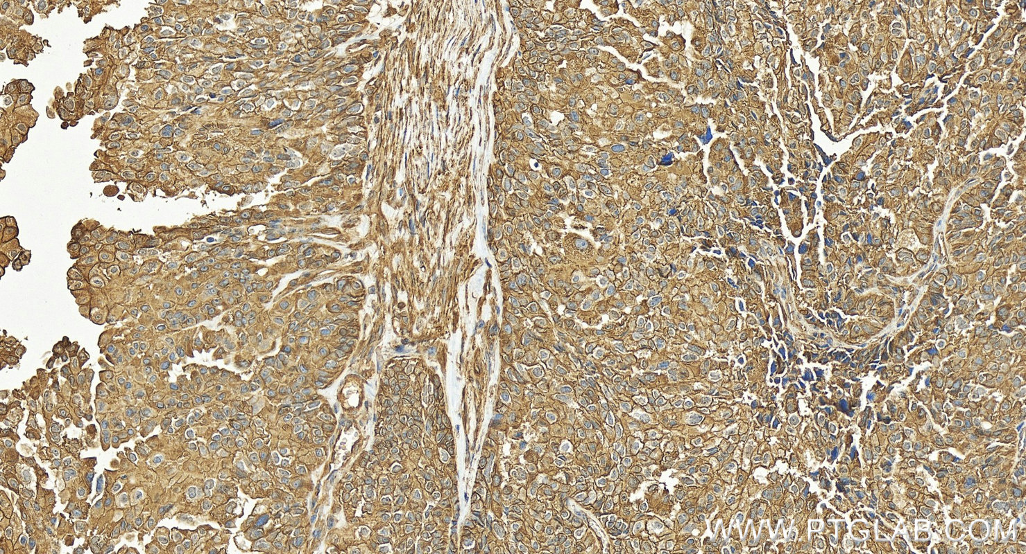 IHC staining of human ovary cancer using 82953-1-RR (same clone as 82953-1-PBS)