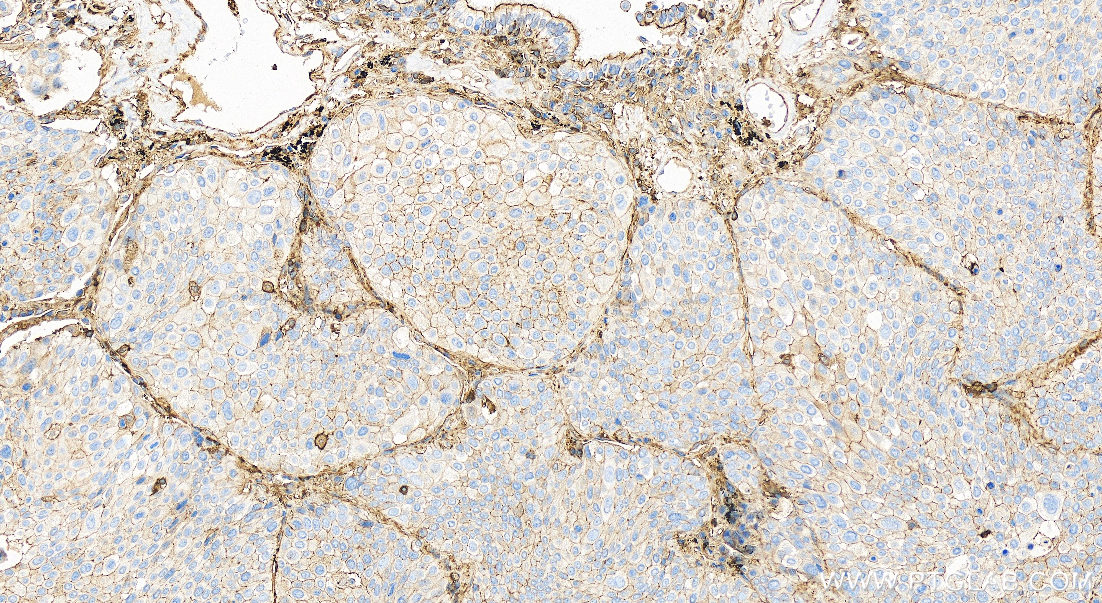 IHC staining of human lung cancer using 82953-2-RR (same clone as 82953-2-PBS)