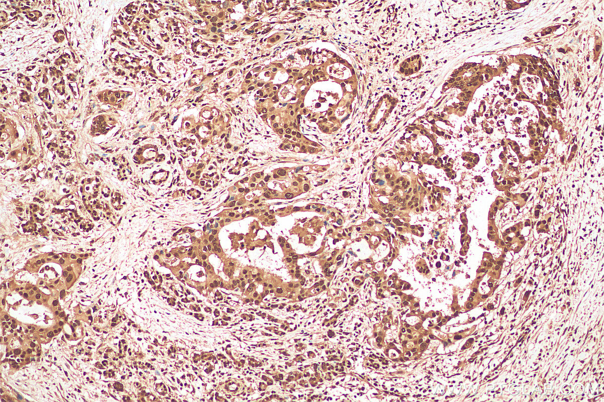 IHC staining of human pancreas cancer using 10201-2-AP