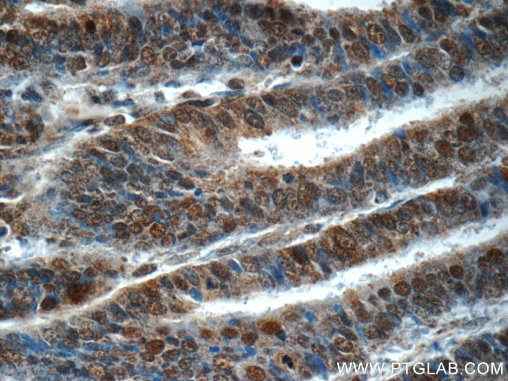 IHC staining of human endometrial cancer using 14946-1-AP