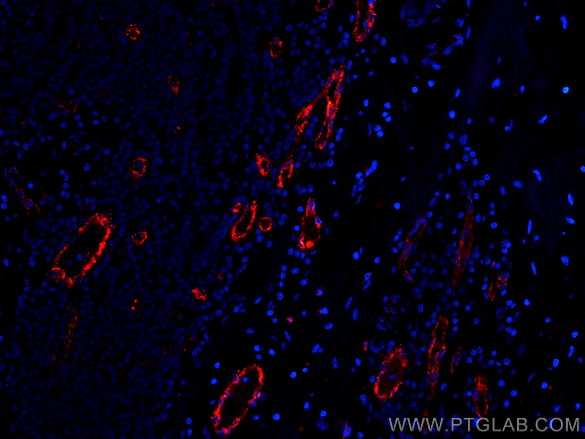 IF Staining of human breast cancer using CL594-66682