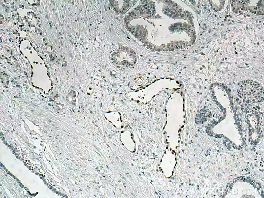 IHC staining of human prostate cancer using ERG polyclonal antibody