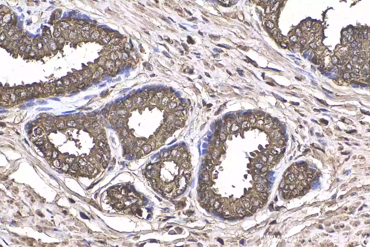 IHC staining of human prostate cancer using KLK3 / PSA polyclonal antibody