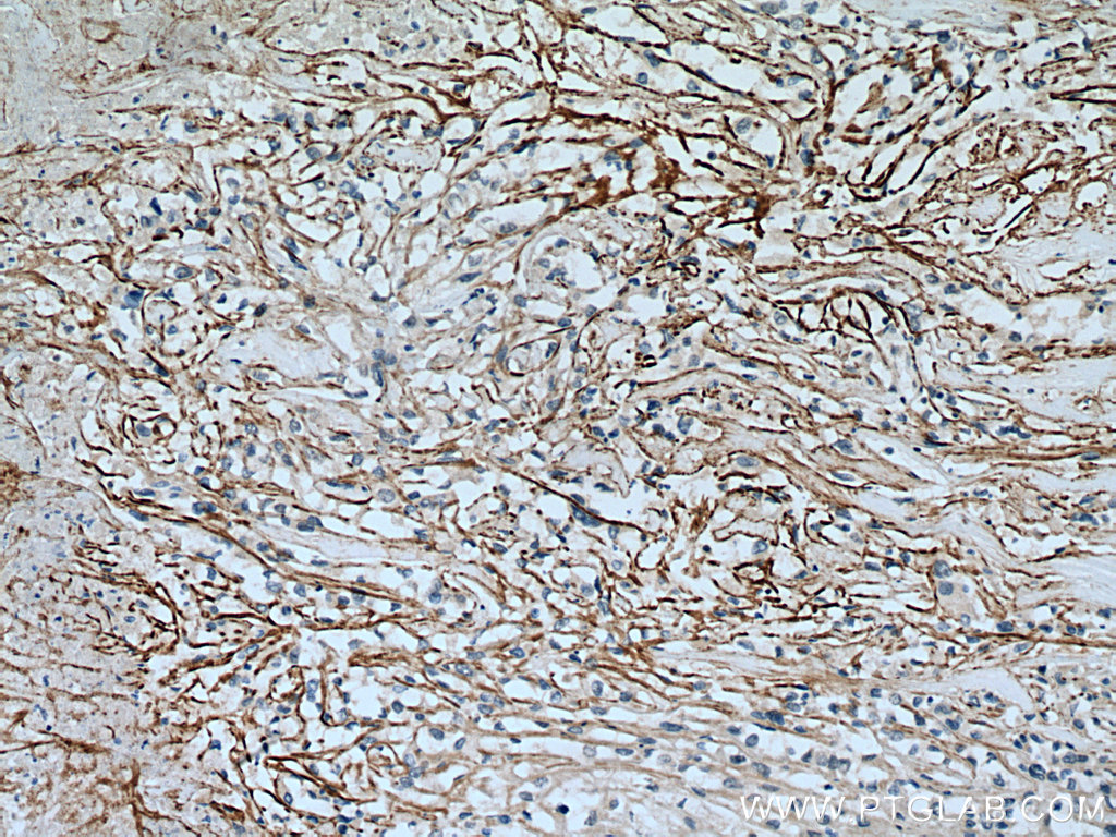 IHC staining of human renal cell carcinoma using 26864-1-AP